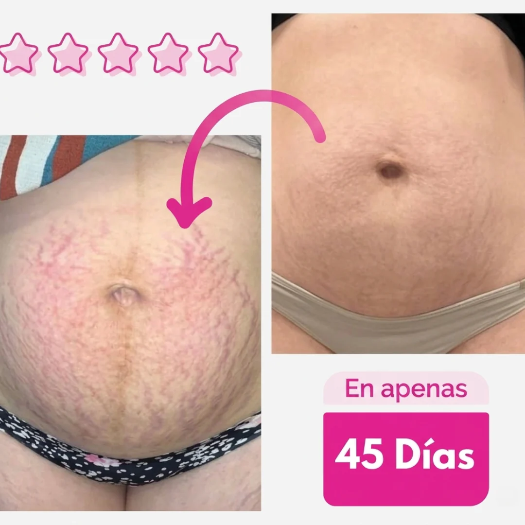 Adeus Crema Brasileña – Crema Rosa Anti-Estrías con Árnica, Jengibre, Cafeína y Té Verde – 300g