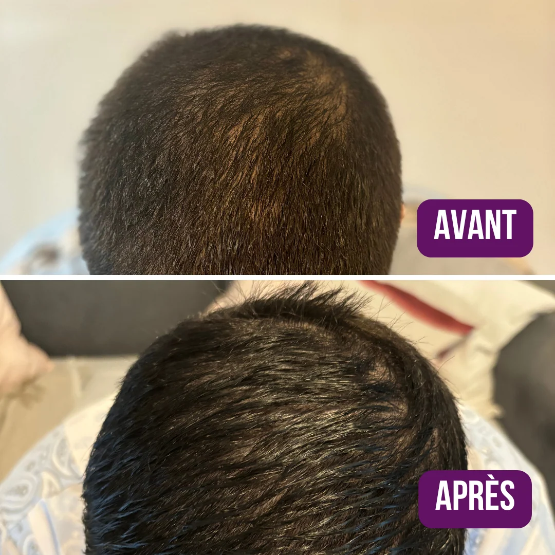Lotion Pousse Extrême & Anti Chute de Cheveux - 100 ml - Sans Rinçage